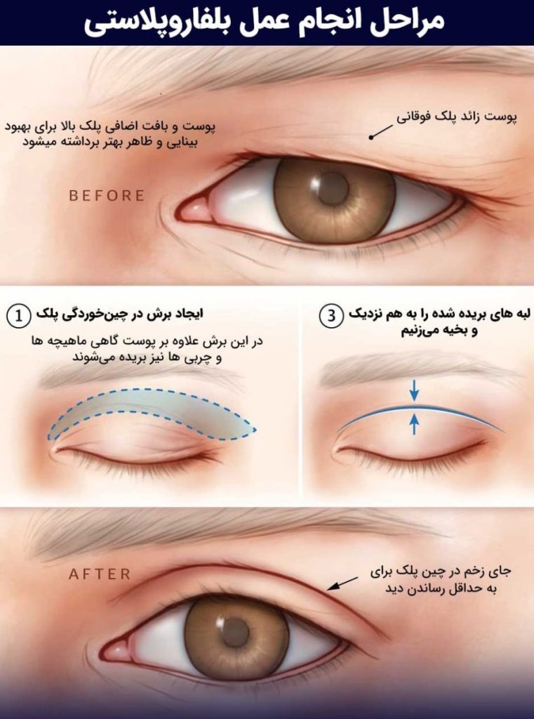 بهترین سن برای عمل بلفاروپلاستی راز جوانی و شادابی در دستان شما