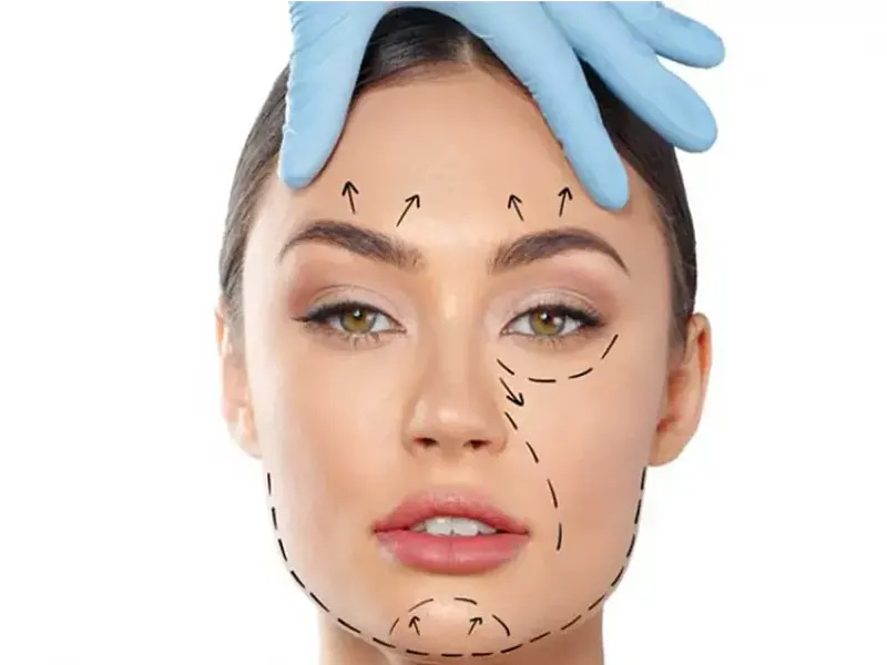 عوارض لیفت صورت با نخ