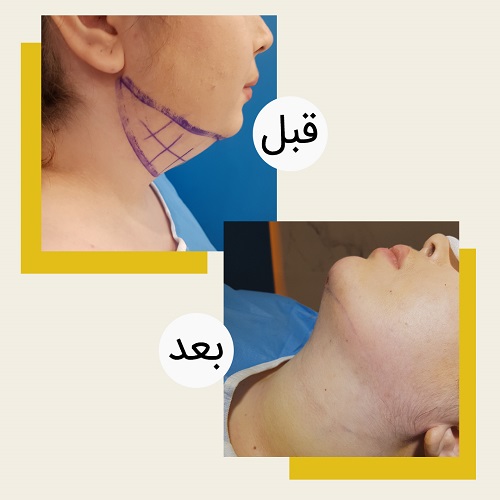 ساکشنولیپوساکشنغبغب_هزینه،مزایاومعایب