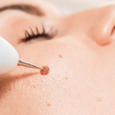 Removal-of-facial-moles2-1