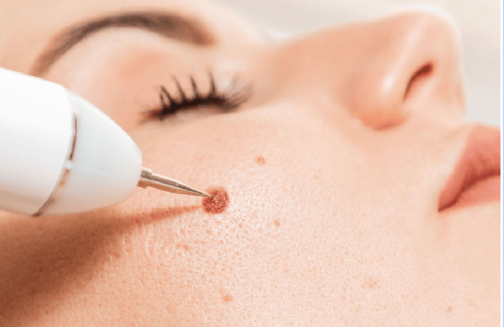 Removal-of-facial-moles2-1