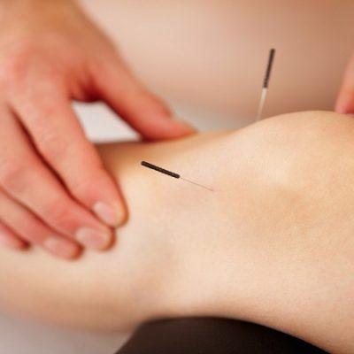 روش-کار-طب-سوزنی