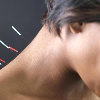 طب-سوزنی-درمان-درد-گردن