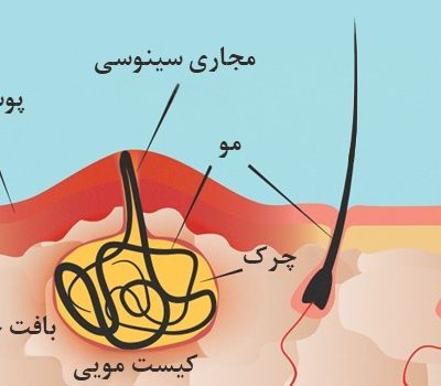 کیست-مویی-چیست؟-علائم،-دلایل-و-درمان