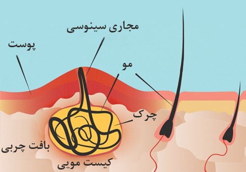 کیست-مویی-چیست؟-علائم،-دلایل-و-درمان