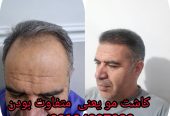 کلینیک کاشت مو و ابرو در لویزان