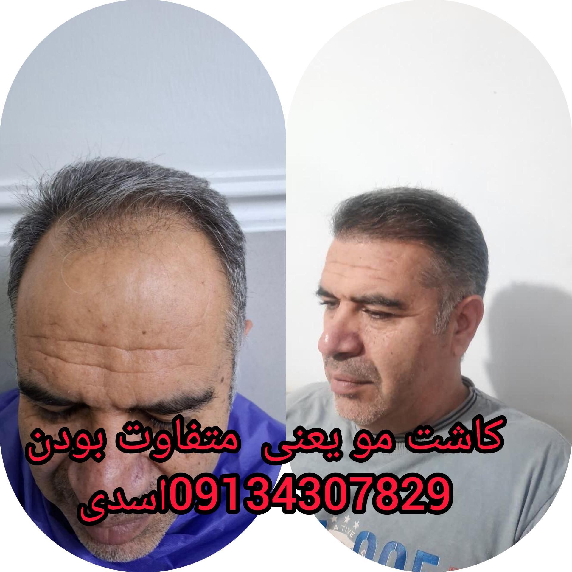 کلینیک کاشت مو و ابرو در لویزان