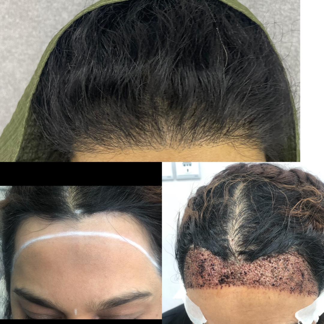 کلینیک کاشت مو و ابرو در لویزان