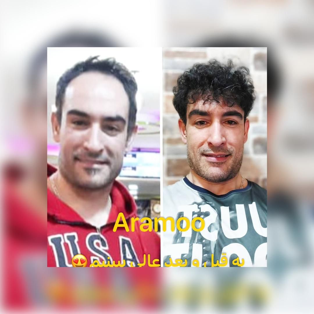 کلینیک کاشت مو و ابرو در لویزان