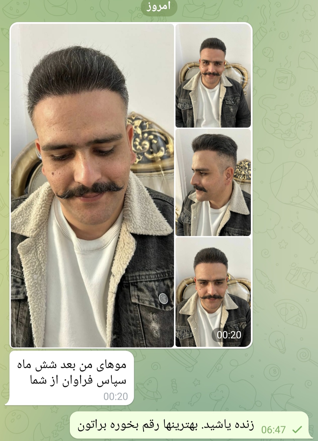 کلینیک کاشت مو و ابرو در لویزان