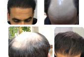 کلینیک کاشت مو و ابرو در لویزان