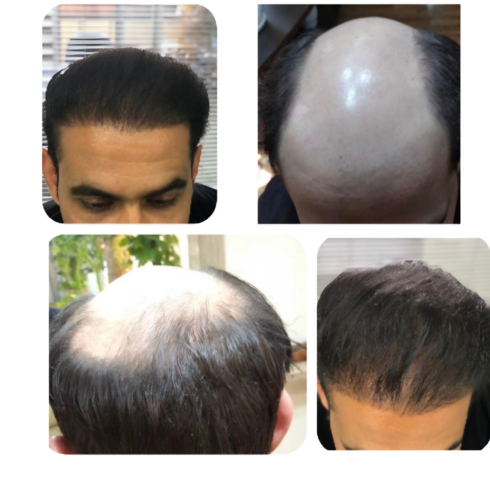 کلینیک کاشت مو و ابرو در لویزان